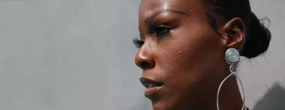 A portrait of Jasmine, an hidradenitis suppurativa (HS) advocate, journalist and filmmaker A portrait of Jasmine, an hidradenitis suppurativa (HS) advocate, journalist and filmmaker